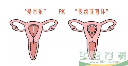 曼月乐环适用哪种人 带曼月乐环都有哪些效果