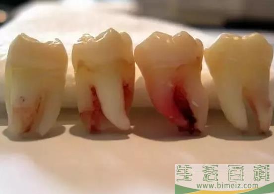 孕妇智齿发炎几天能好 孕妇智齿发炎可以拔牙吗