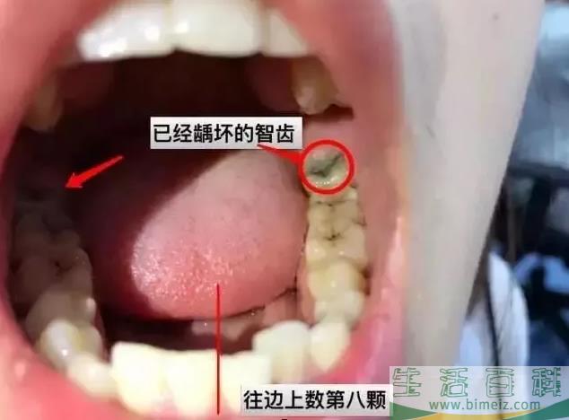 孕妇智齿发炎几天能好 孕妇智齿发炎可以拔牙吗 孕妇智齿发炎几天能好 孕妇智齿发炎可以拔牙吗