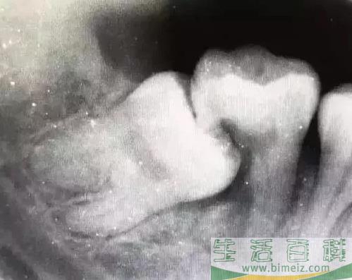 孕妇智齿发炎几天能好 孕妇智齿发炎可以拔牙吗 孕妇智齿发炎几天能好 孕妇智齿发炎可以拔牙吗
