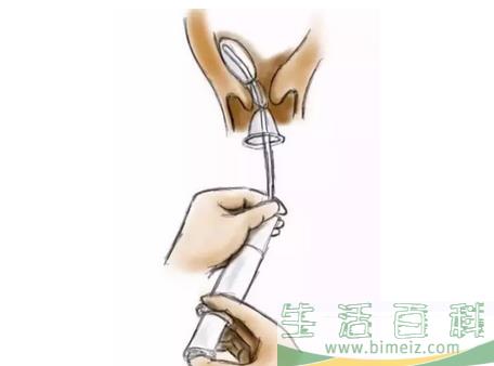 给孕妇用水囊引产有什么用 水囊引产有什么要注意的