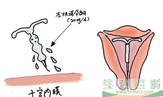 上曼月乐环后子宫会越来越大吗 上曼月乐环对子宫影响