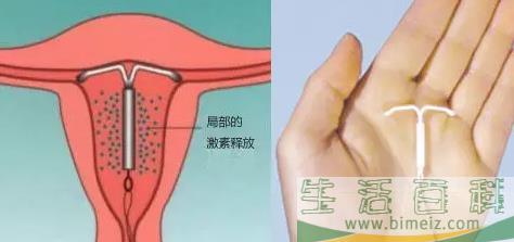 上曼月乐环后流血怎么回事 上曼月乐环流血是副作用吗