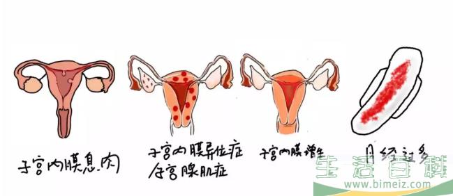 上曼月乐环不来月经正常吗 上曼月乐环月经量减少有影响吗