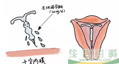 上曼月乐环不来月经正常吗 上曼月乐环月经量减少有影响吗
