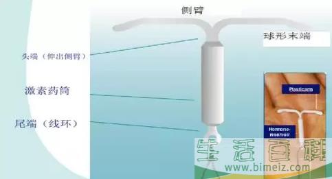 上曼月乐环不会痛经吗 上曼月乐环会缓解痛经吗