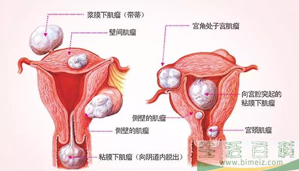 孕晚期子宫肌瘤对母体和胎儿的影响 妊娠合并子宫肌瘤处理方法
