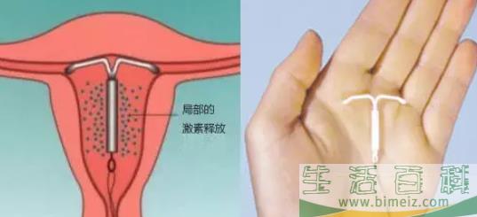 上曼月乐环会脸上长痘吗 曼月乐环孕激素会引起长痘吗