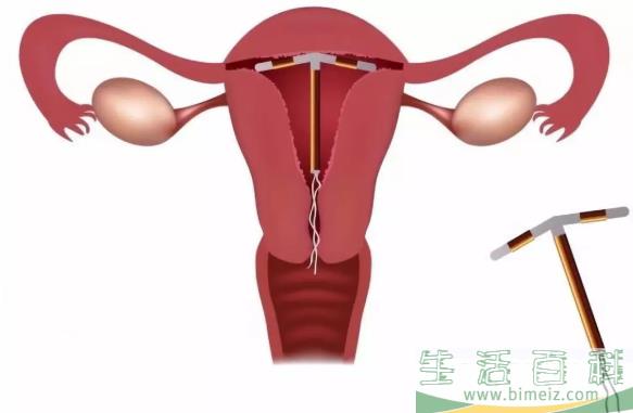 上曼月乐环后多久可以性生活 放置曼月乐环需要卧床休息吗