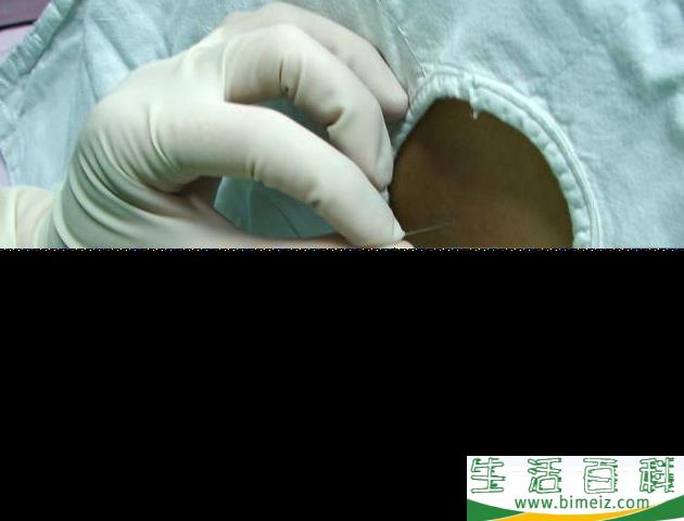 剖腹产打麻药打哪里 剖腹产打麻药有什么感觉