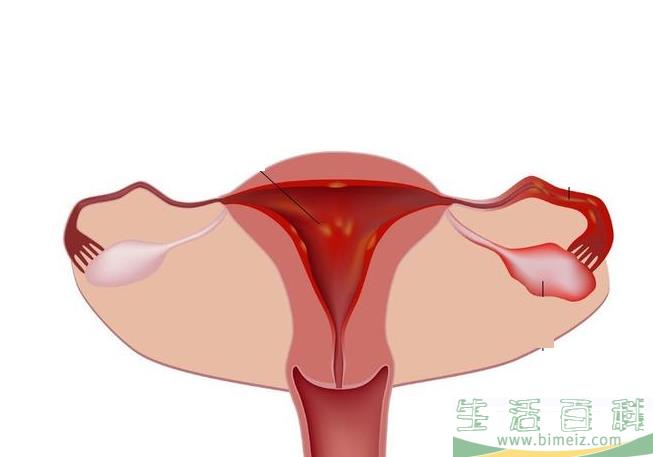女性盆腔炎会自愈吗 盆腔炎怎么治疗