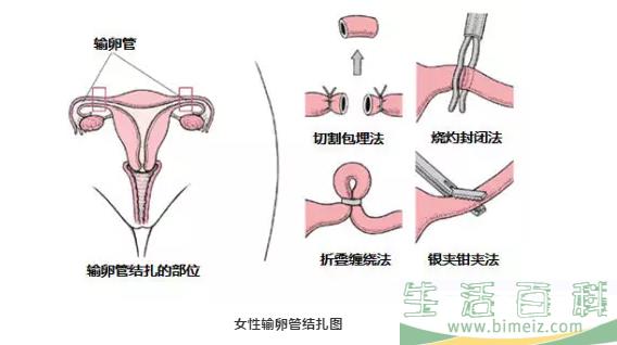 女性上环后还能怀孕吗 上环后还想要小孩怎么办