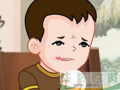 口角炎吃什么好 口角炎不适合吃什么食物
