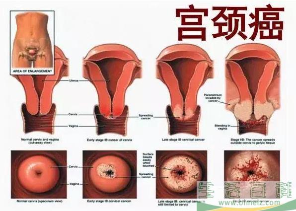 HPV日常接触中会传染吗 HPV的传播途径是什么