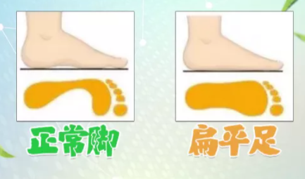 怎样辨别扁平足3