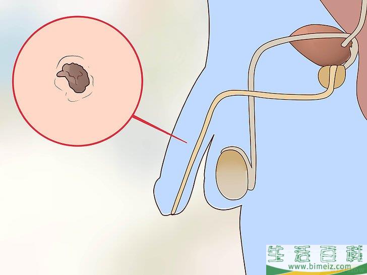 如何检查阴茎是否有性病感染迹象