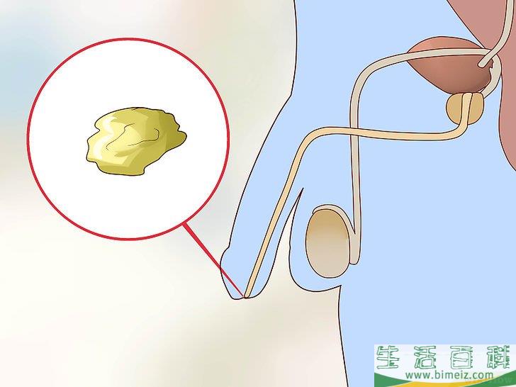 如何检查阴茎是否有性病感染迹象