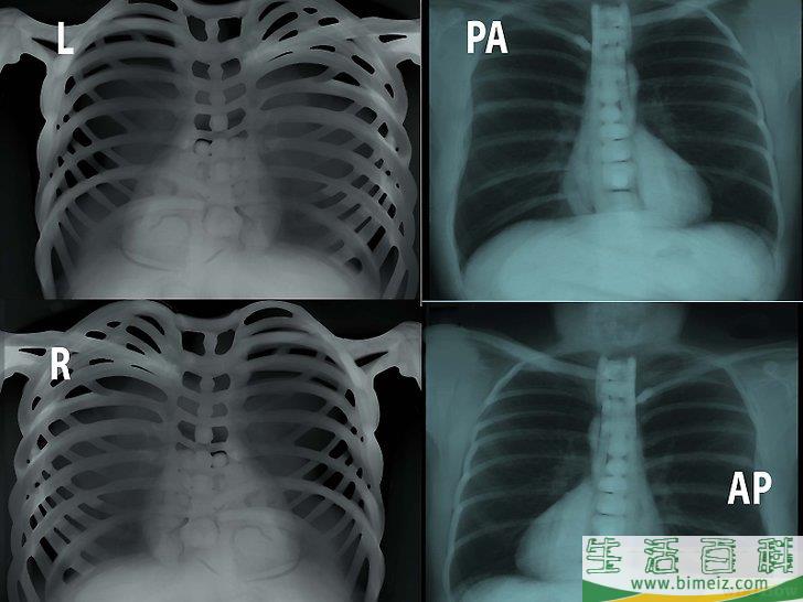 如何看胸部平片