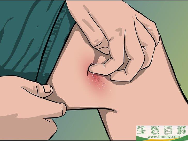 如何治疗毒漆藤皮疹